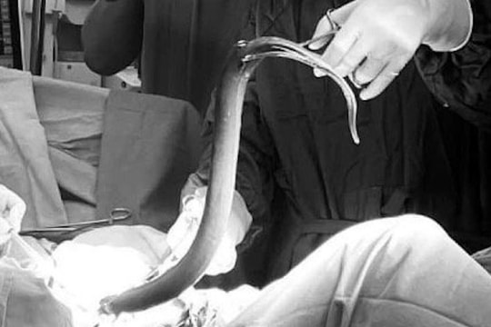 Nam thanh niên suýt mất mạng vì nhét con lươn vào hậu môn