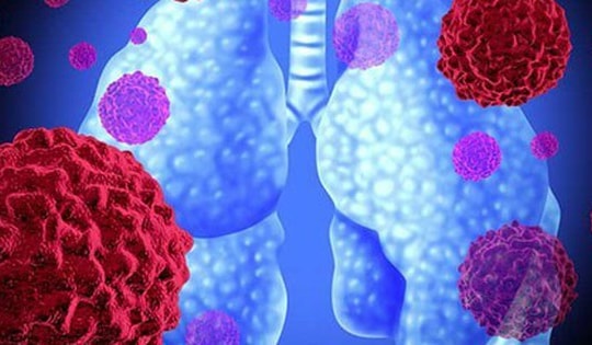 Viêm phổi ở người cao tuổi những lưu ý không thể bỏ qua