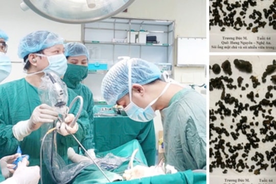 Mổ nội soi lấy gần 1.000 viên sỏi đường mật trong gan bệnh nhân