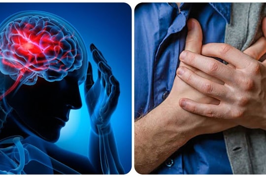 Nên làm gì khi có dấu hiệu đột quỵ?