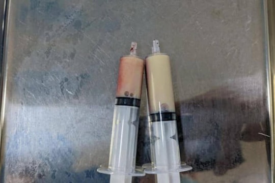 Cấp cứu người đàn ông bị mỡ máu 'đông đặc'