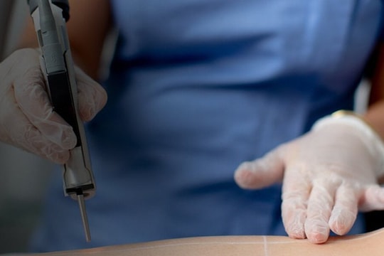 Có nên triệt lông vùng kín?