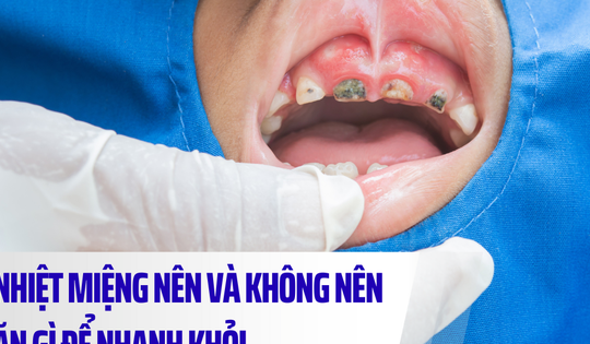 Nhiệt miệng nên ăn gì và kiêng gì để nhanh khỏi?
