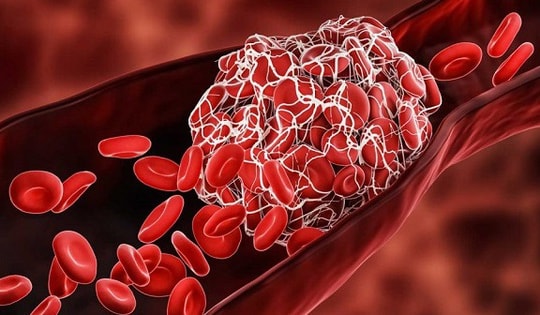 Cảnh giác 4 nhóm thực phẩm quen thuộc dùng nhiều tăng nguy cơ đột quỵ