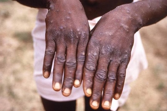 WHO sẽ họp khẩn vì đậu mùa khỉ