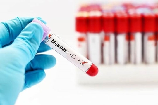 TP.HCM ghi nhận 3 trẻ tử vong liên quan bệnh sởi