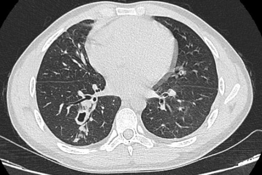 Ho ra máu, đi khám phát hiện sán làm tổ trong phổi