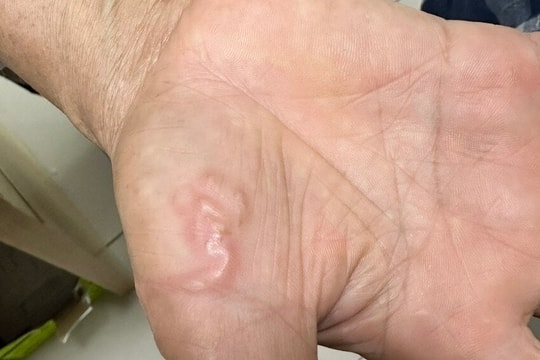 Giun đũa bò lúc nhúc dưới da của người phụ nữ nuôi 8 con chó, mèo