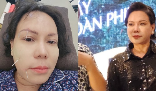 Việt Hương: "Dây thần kinh số 7 không bị đứt mà nó co rút khiến mặt tôi biến dạng"