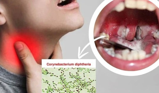 Ai có nguy cơ cao mắc bệnh bạch hầu? 5 nhóm người này cần cảnh giác