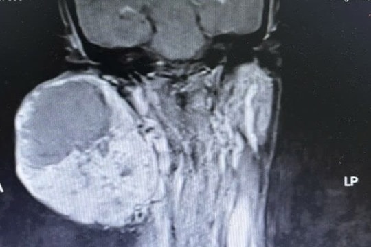 Suýt mất mạng vì mang khối u khổng lồ 14 năm không điều trị