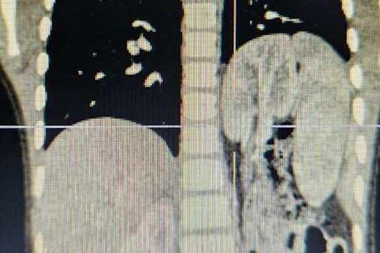 Bé trai nguy kịch do nội tạng chui lên lồng ngực