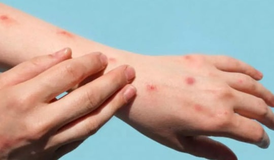 WHO ban bố tình trạng khẩn cấp toàn cầu vì bệnh đậu mùa khỉ