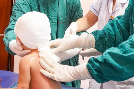 Bé ngã vào bát canh nóng, bôi mỡ trăn khiến bỏng càng nặng: Bác sĩ cảnh báo