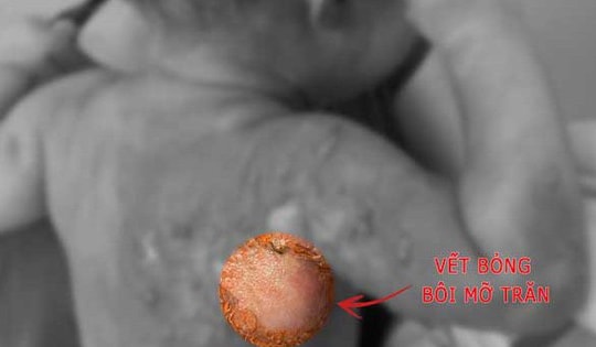 Bé gái 1 tuổi ở Bắc Ninh nhập viện do thói quen chữa bỏng nhiều người hay mắc phải