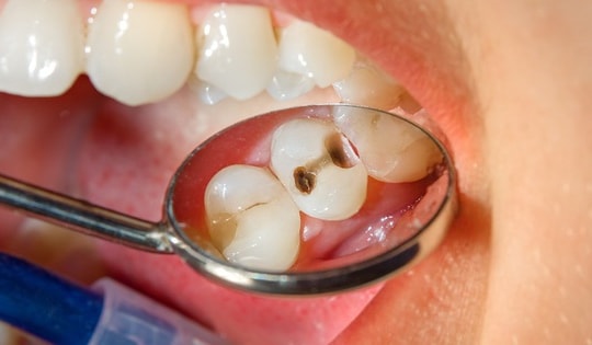 Cách chăm sóc răng miệng để cơ thể khỏe mạnh