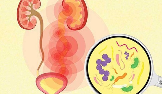 6 cách xử trí khi bị nhiễm trùng đường tiết niệu