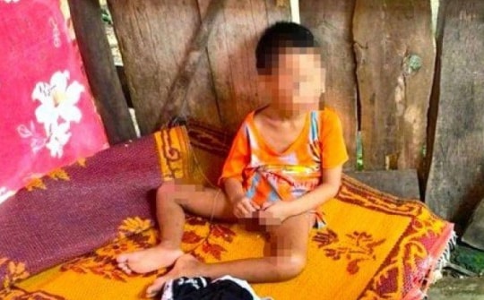 Bé 5 tuổi có nhiều vết thương bị đưa ra ở riêng trong lán tạm