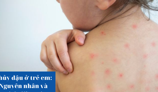 Thủy đậu ở trẻ em: Nguyên nhân và cách điều trị
