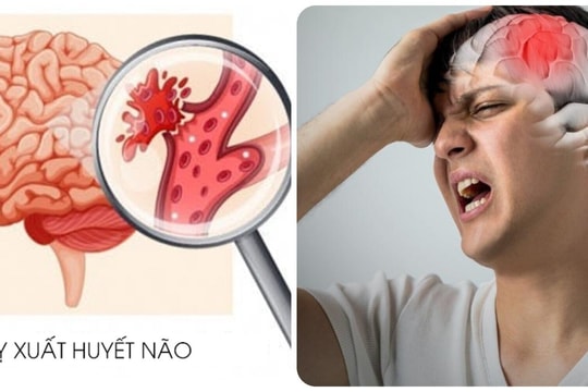 Đột quỵ não nguy hiểm thế nào?