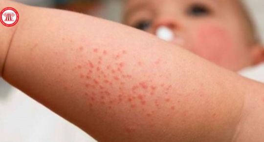 Công bố dịch sởi trên địa bàn TPHCM năm 2024