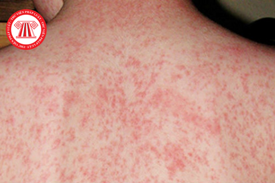 Bệnh sởi là gì? Đối tượng nào được tiêm chủng vắc xin phòng, chống dịch sởi năm 2024?