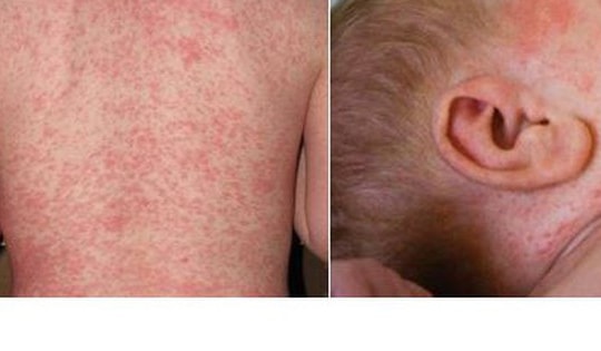 Bệnh sởi có xu hướng gia tăng, làm sao để phòng ngừa bệnh cho trẻ