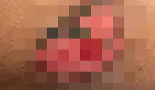 Tự mua thuốc điều trị gout, người đàn ông 58 tuổi nhập viện cấp cứu