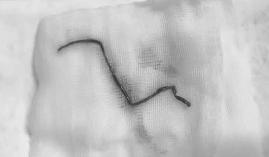 Người đàn ông 60 tuổi ở Phú Thọ có cục máu đông dài gần 10 cm trong mạch máu não