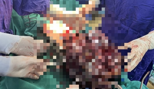 Người phụ nữ 53 tuổi ở Hà Nội vác khối u 'khủng' hơn 7kg trong bụng