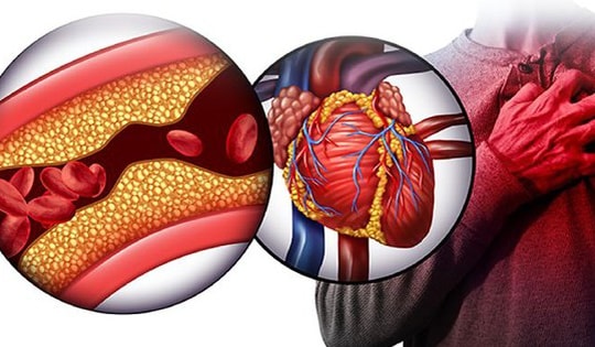 Dấu hiệu cảnh báo máu nhiễm mỡ, những người có nguy cơ mắc cao hơn người khác