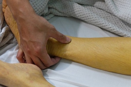 Da vàng như nghệ sau khi uống thuốc mua trên mạng