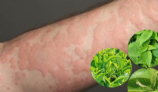 Em bé sơ sinh bị nhiễm trùng huyết sau khi tắm thứ này