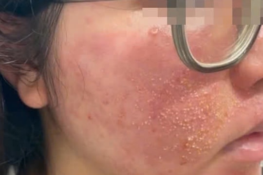 'Nát mặt' vì mua mỹ phẩm trị mụn theo quảng cáo trên mạng