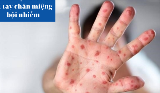 Cách nhận biết trẻ bị tay chân miệng bội nhiễm