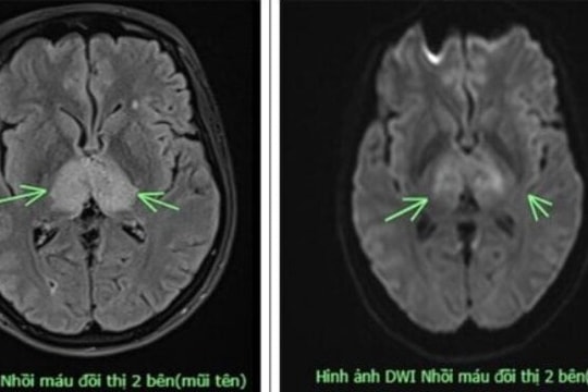 Đau đầu suốt 4 ngày không khỏi, đi khám mới biết mắc bệnh nguy hiểm, hiếm gặp