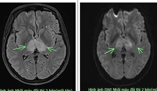 Đau đầu 4 ngày uống thuốc không đỡ, người phụ nữ 38 tuổi mắc bệnh nguy hiểm ở não