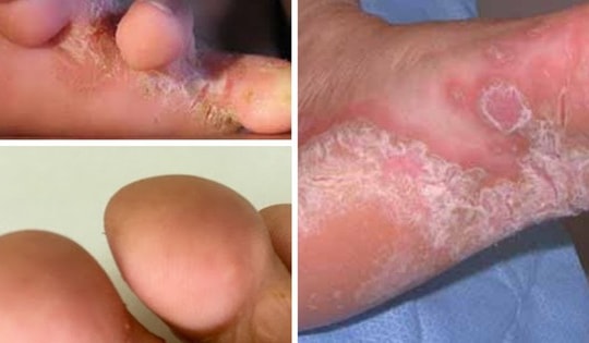 Gia tăng bệnh nhân đến viện khám vì các bệnh về da sau bão, lũ