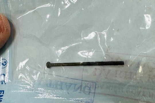 Gắp đinh vít dài 4 cm trong dạ dày bé trai 3 tuổi ở Quảng Ngãi