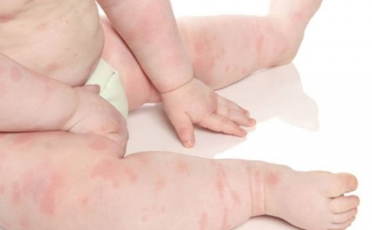 5 bệnh về da phổ biến ở trẻ và hậu quả khôn lường nếu mẹ lơ là