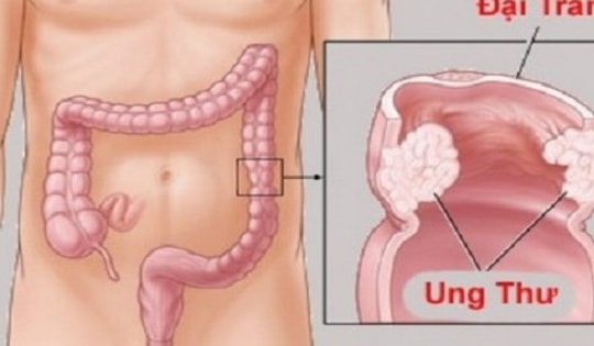 2 mẹ con cùng mắc ung thư thừa nhận một sai lầm nhiều người Việt mắc phải