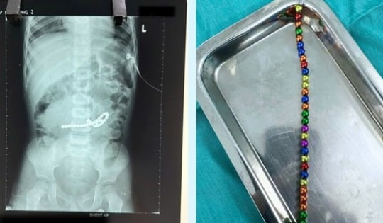 Đau bụng, bé 3 tuổi ở TPHCM đi khám phát hiện thủng nhiều đoạn ruột vì nuốt 31 viên nam châm đồ chơi