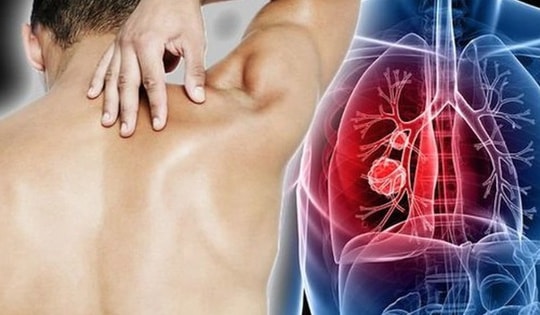 Người đàn ông 29 tuổi bất ngờ phát hiện ung thư phổi, thừa nhận có một sai lầm nhiều nam giới Việt mắc phải