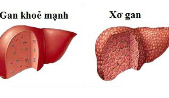 Biểu hiện nhận biết các giai đoạn của bệnh xơ gan