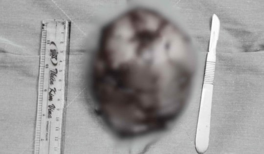 Thấy ngực to bất thường, cô gái 28 tuổi đi khám bất ngờ phát hiện khối u kích thước 'khổng lồ'