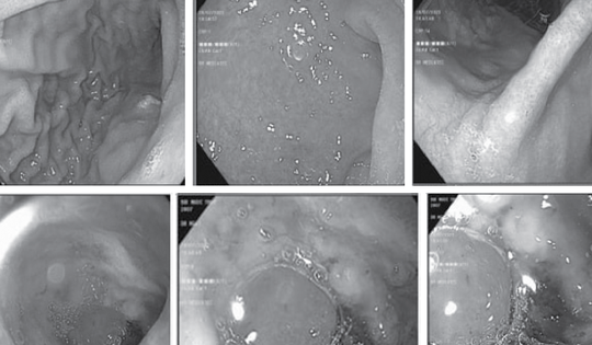 Nữ sinh 16 tuổi xuất huyết dạ dày thừa nhận thường xuyên làm việc này sau bữa ăn