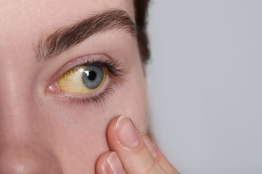 7 dấu hiệu nhận biết sớm bệnh gan nhiễm mỡ