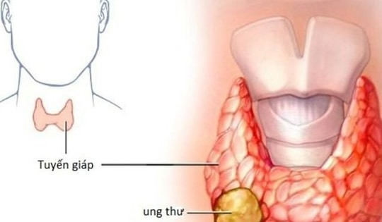 Các dấu hiệu điển hình của ung thư tuyến giáp ai cũng cần biết