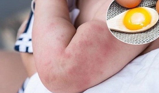 Trẻ 6 tháng tuổi nguy kịch sau khi ăn trứng gà, những ai cần lưu ý khi ăn loại thực phẩm bổ dưỡng này?
