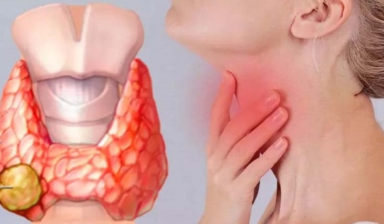6 nhóm người dễ mắc ung thư tuyến giáp, ai có dấu hiệu này cần cảnh giác